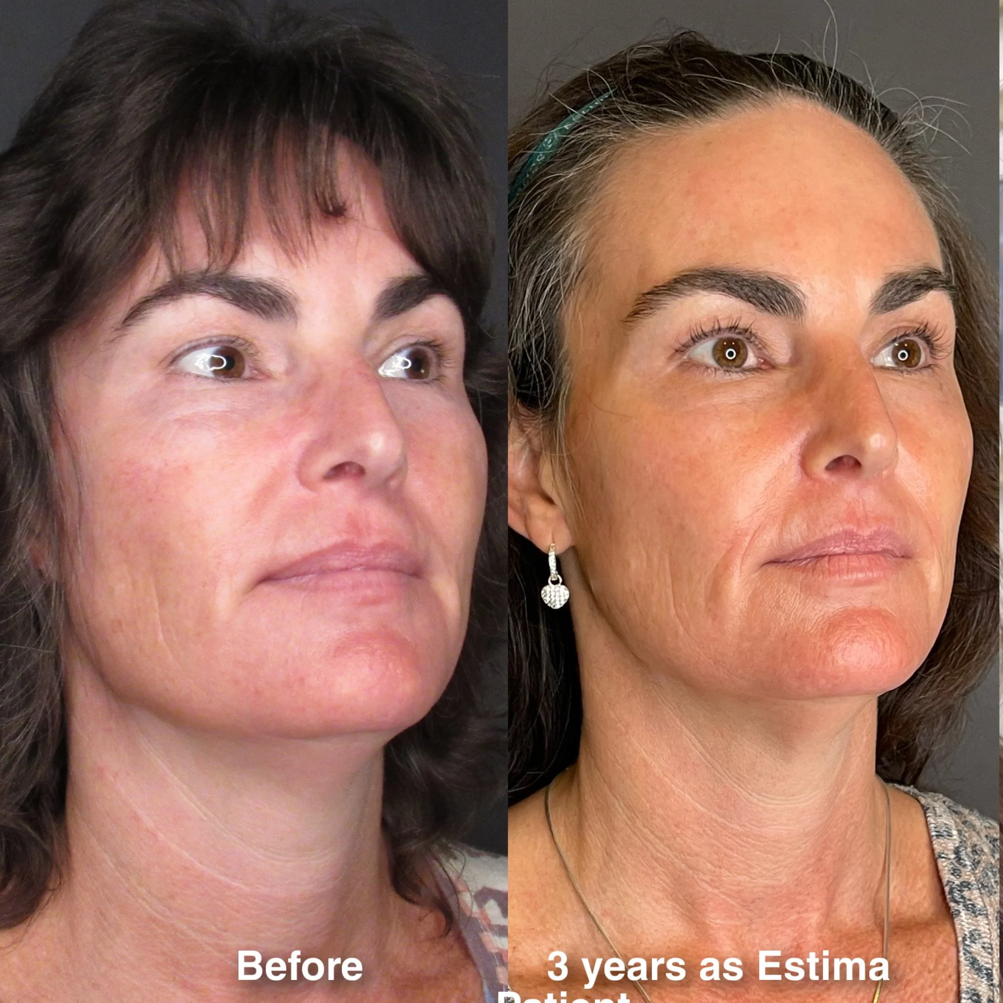 Before & After full assessment and treatment as Estima including a variety of treatments specific to the individual's goals