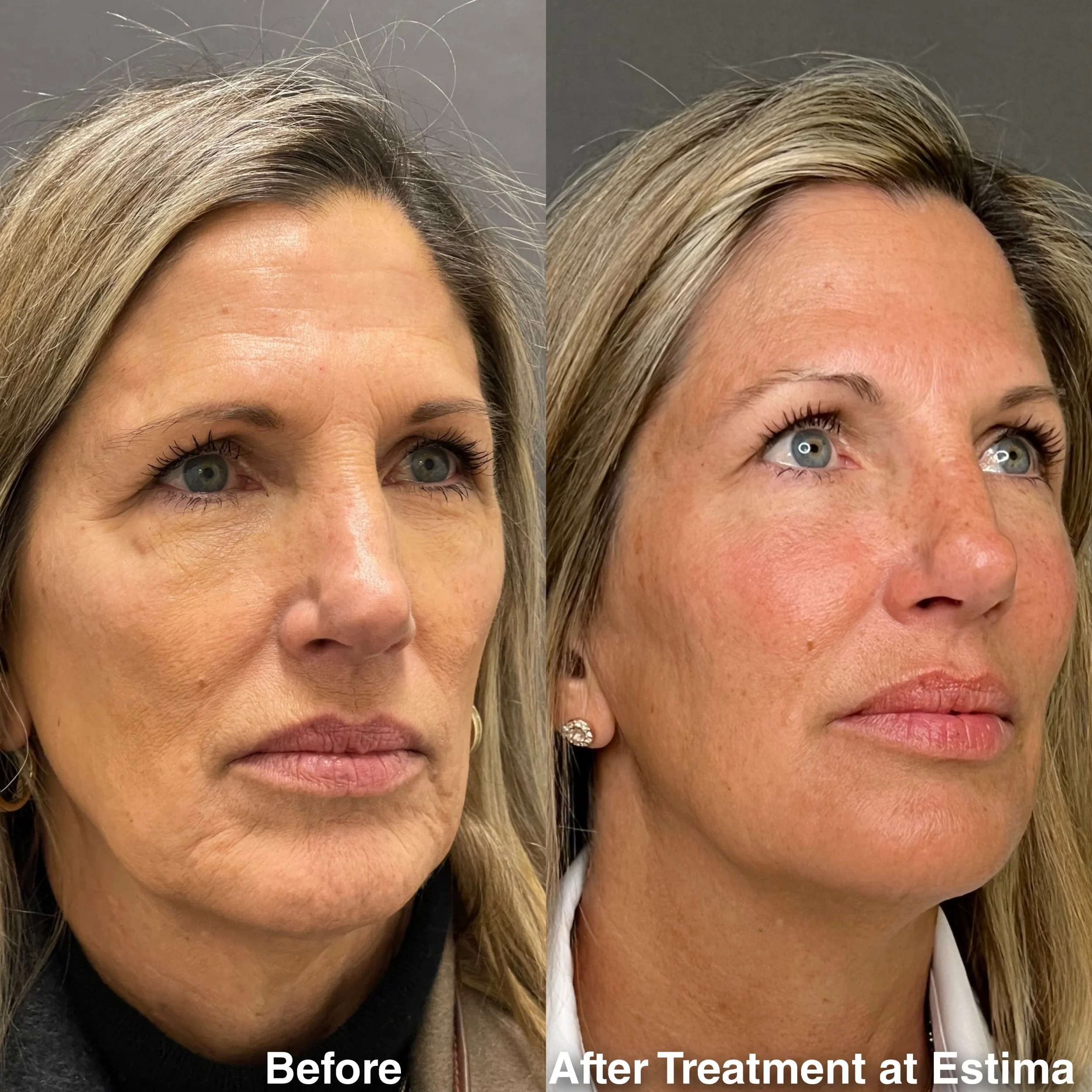 Before & After full assessment and treatment as Estima including a variety of treatments specific to the individual's goals