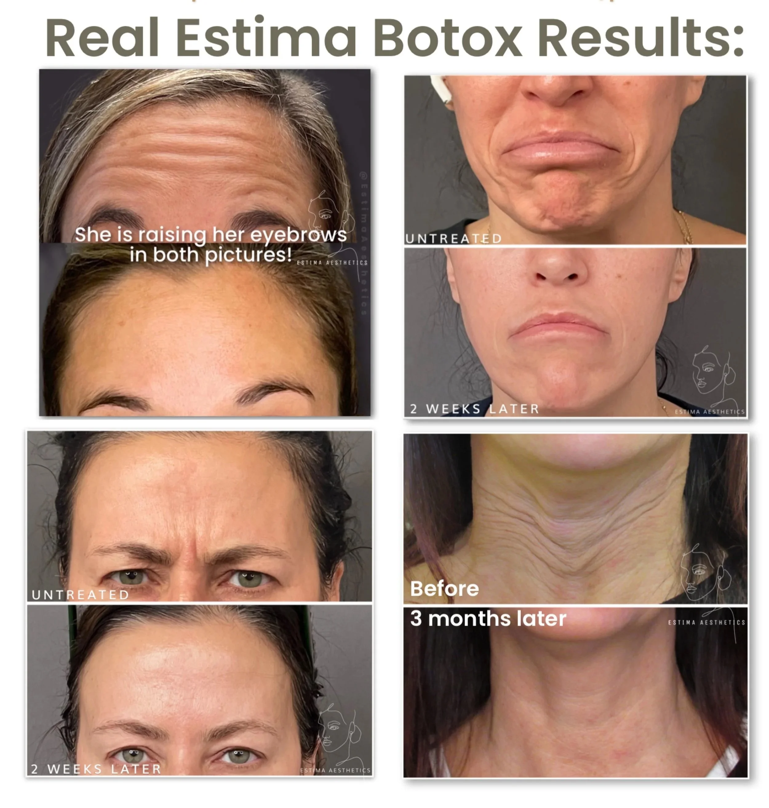 Before & after Estima botox treatments