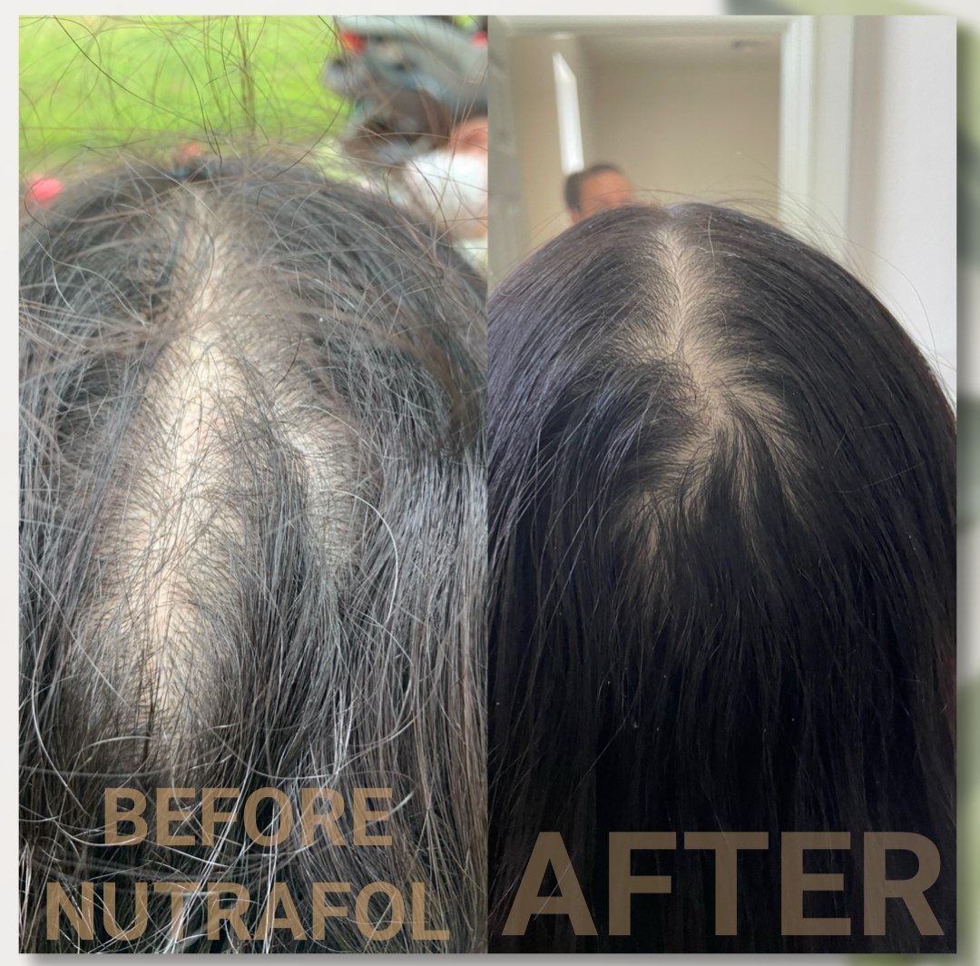 Before & after nutrafol