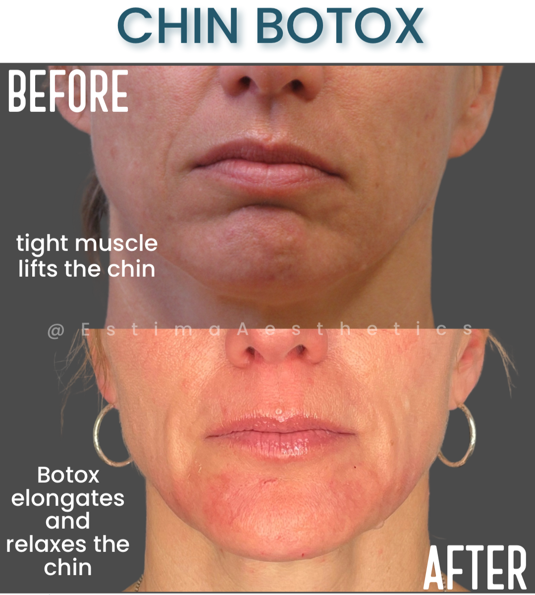 Before and after Chin Botox at Estima