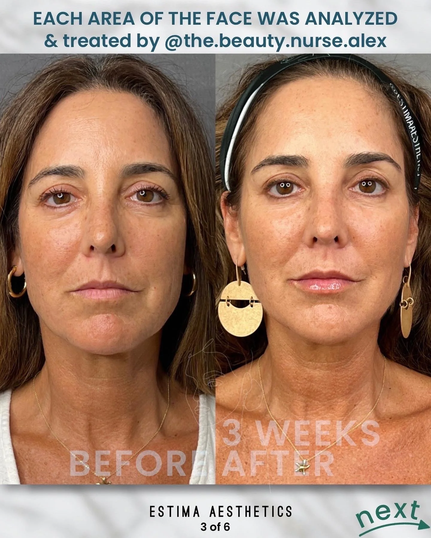 Before & After full assessment and treatment as Estima including a variety of treatments specific to the individual's goals