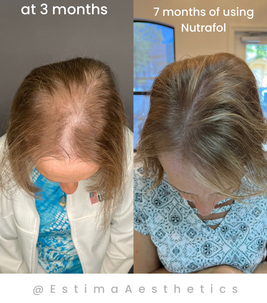 7 months using nutrafol before and after you can see the greater density of hair  at her part