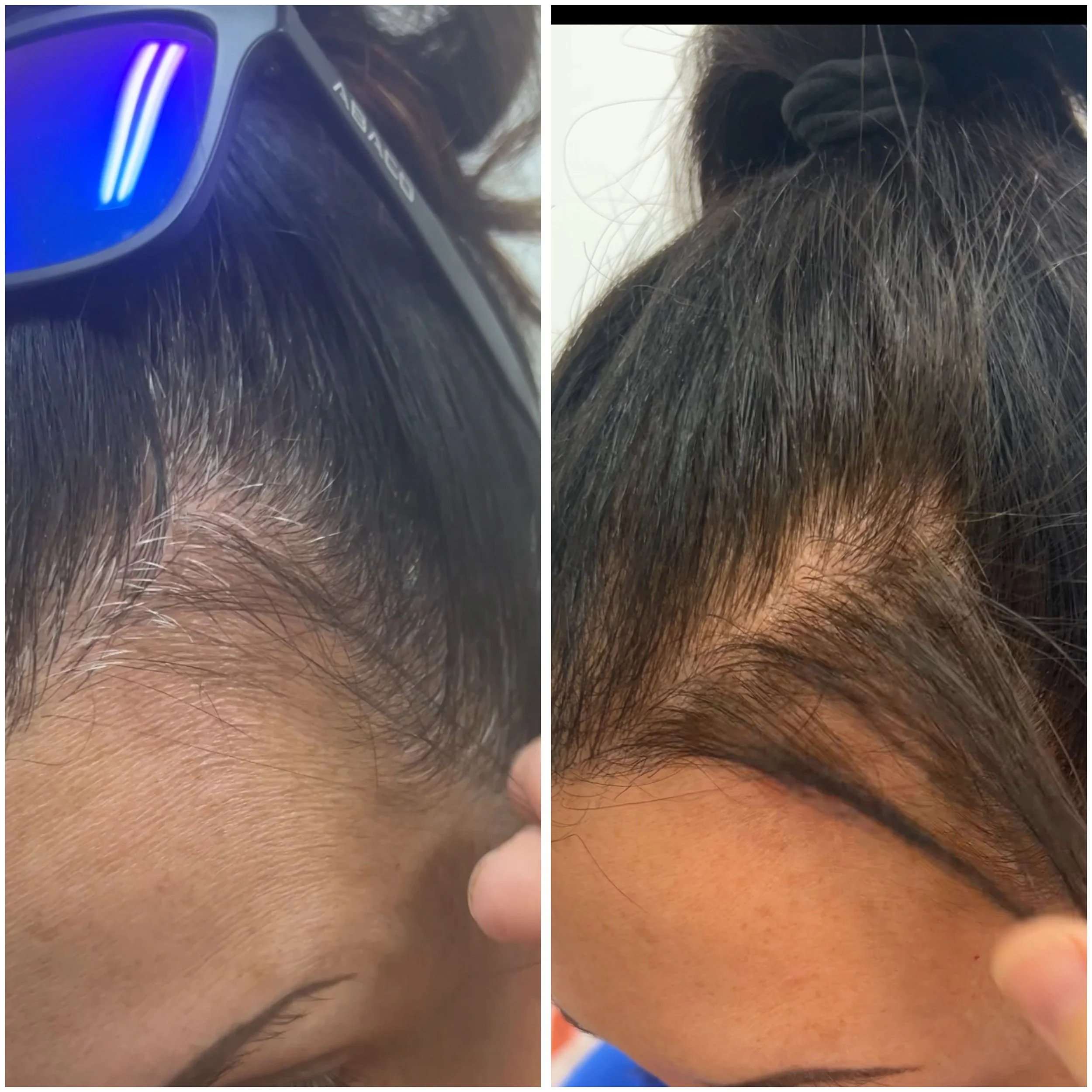 Before and after 1 treatment for hair loss at Estima Aesthetics. This close up photo clearly shows the increase of hair density at the hairline