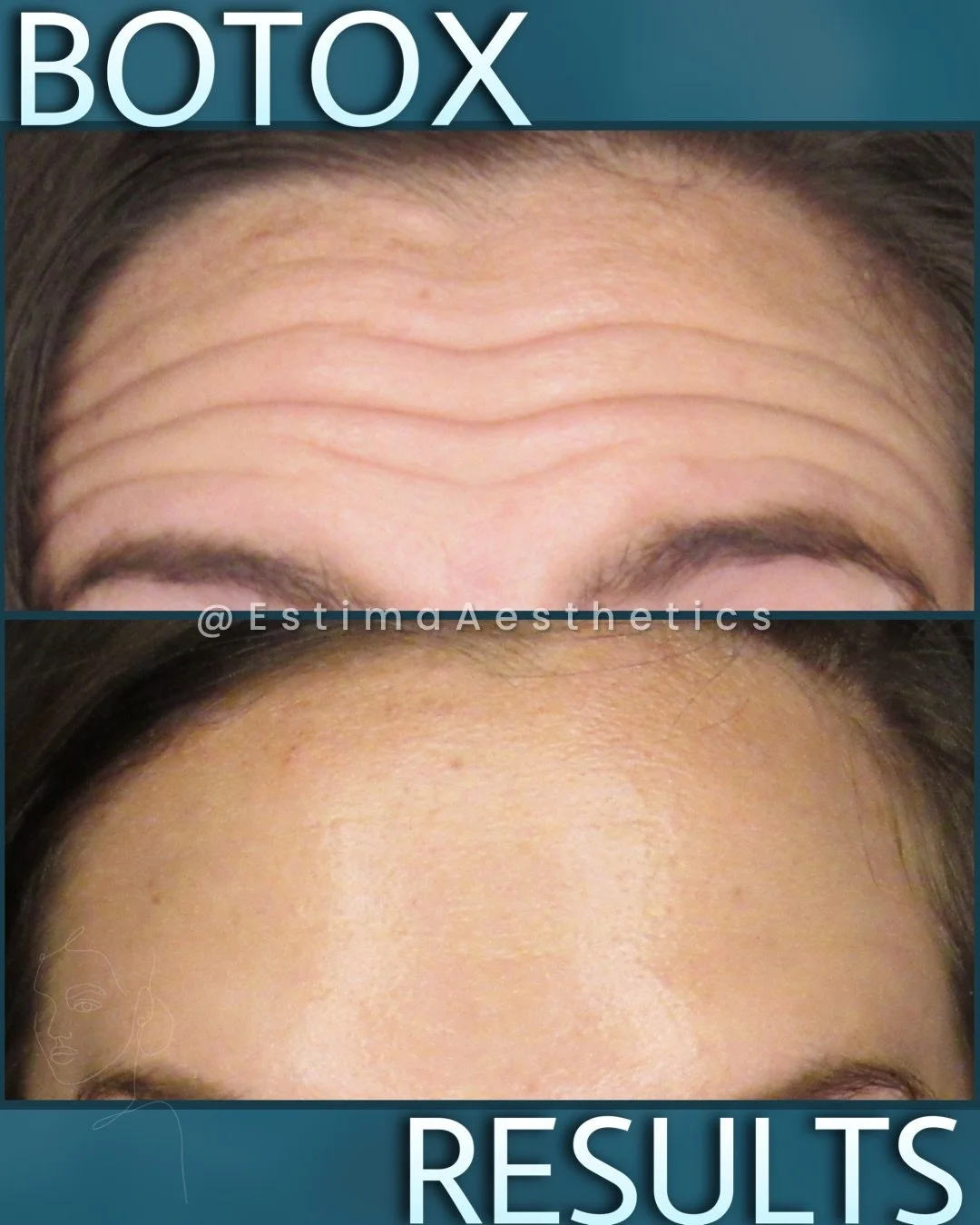 Before and after top 3 area Botox to ensure a smooth and natural result