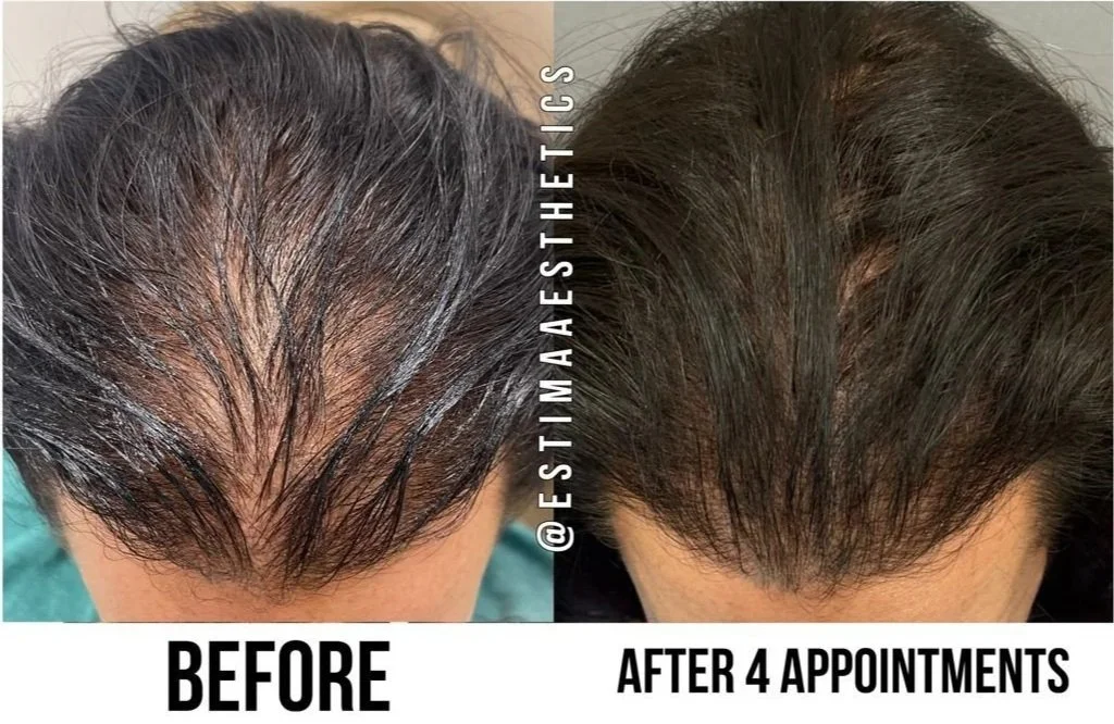 Before & After of top of female's head to show improvement in hair regrowth treatments at Estima Aesthetics before and then after 4 treatments.