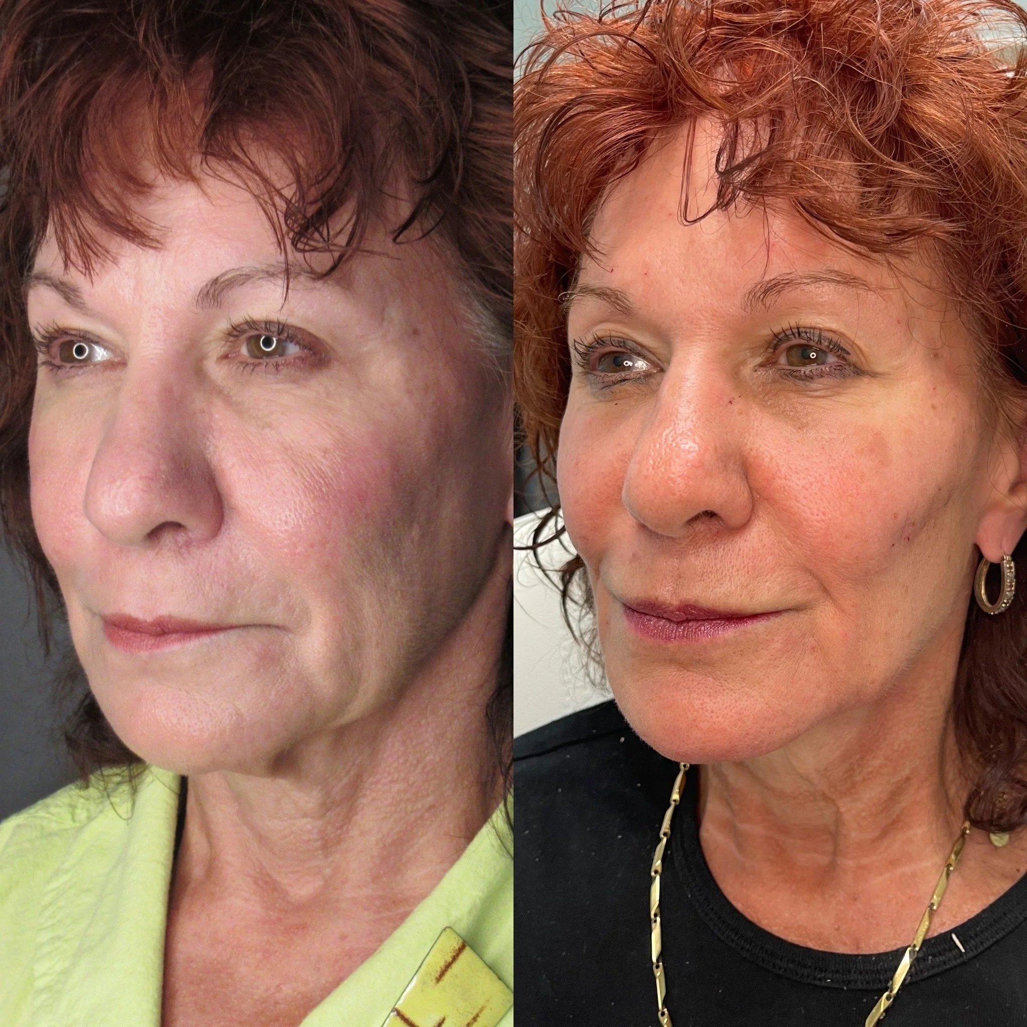 Before & After full assessment and treatment as Estima including a variety of treatments specific to the individual's goals