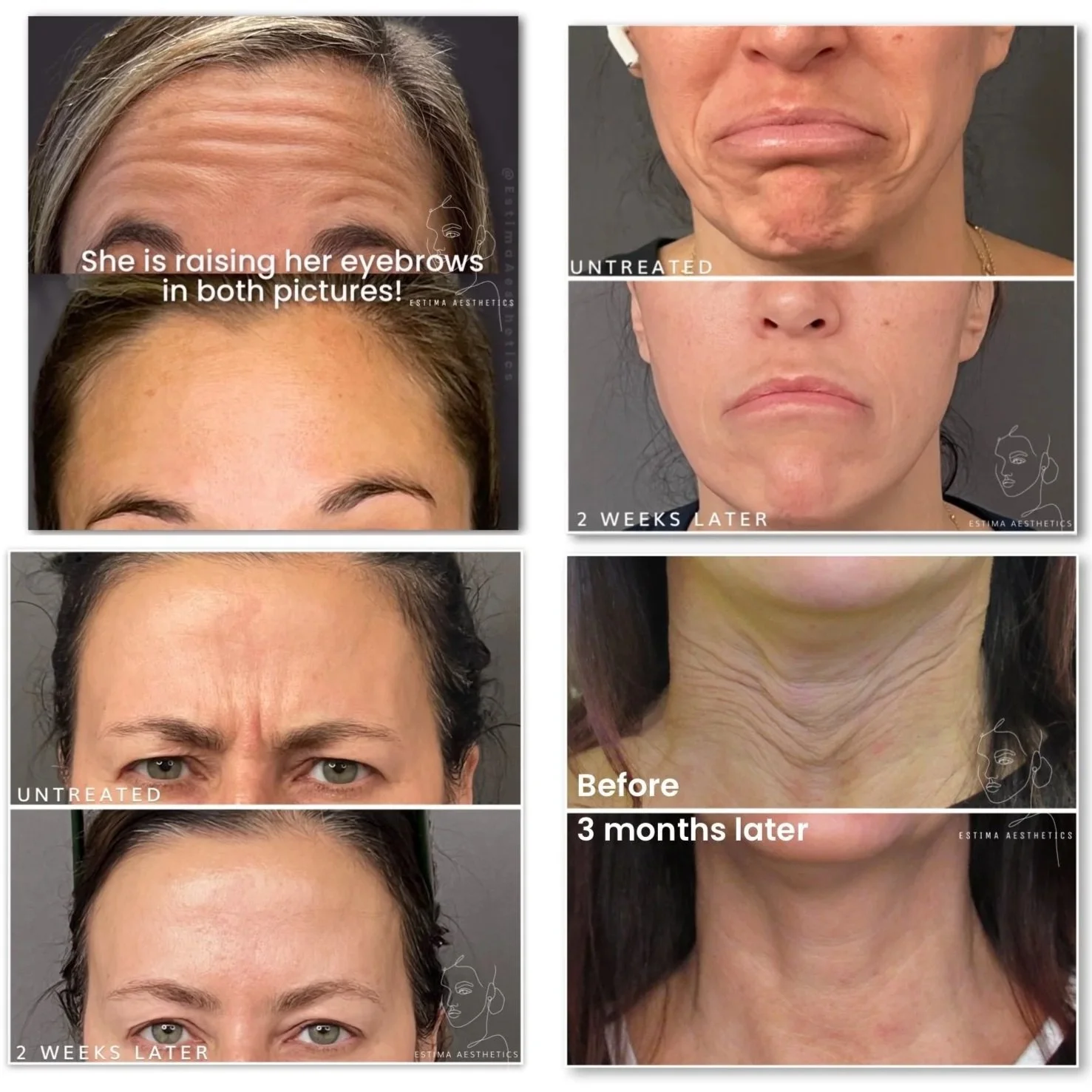 4 before and after of Botox results at Estima Aesthetics. Book your appointment now call us 386-53-BOTOX