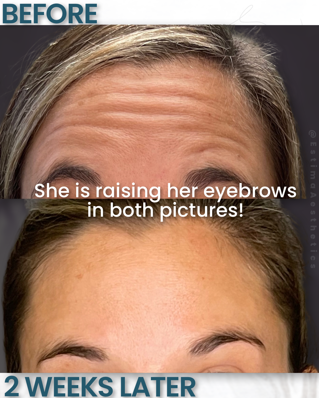 Before and after top 3 area Botox to ensure a smooth and natural result
