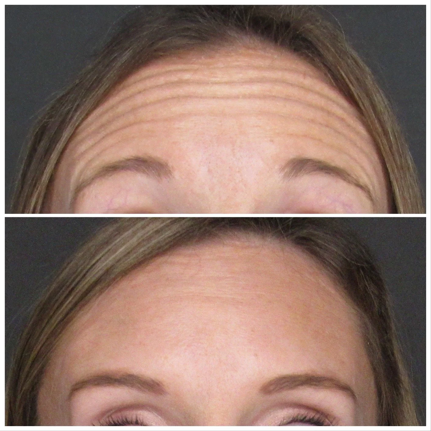 Before and after top 3 area Botox to ensure a smooth and natural result