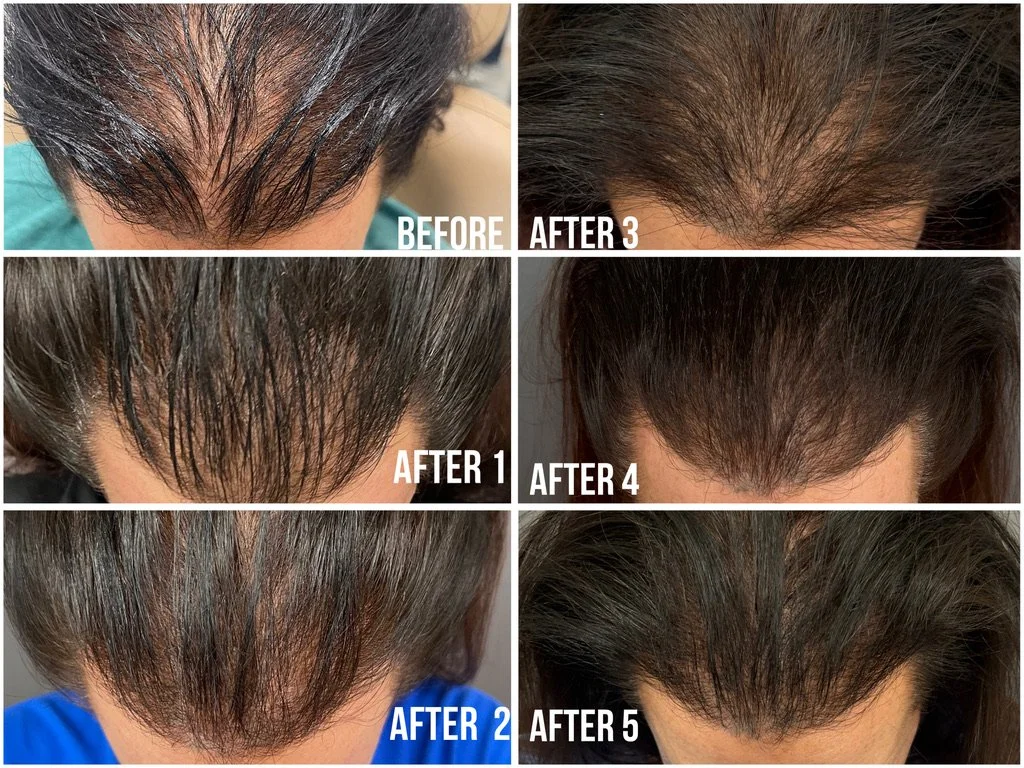 Progression over 5 treatments of PRF Hair Restoration treatment at Estima