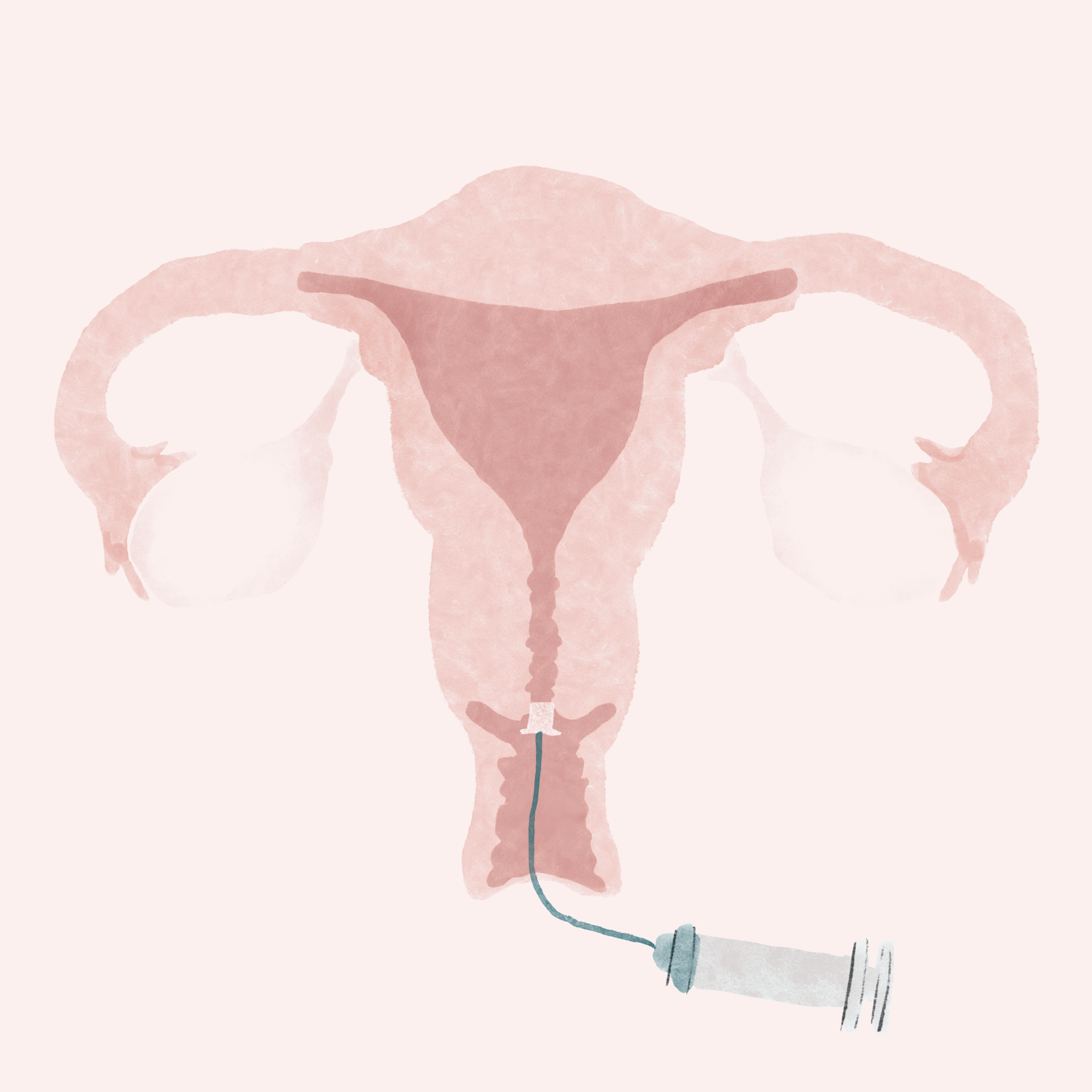 Hysterosalpingogram (HSG)