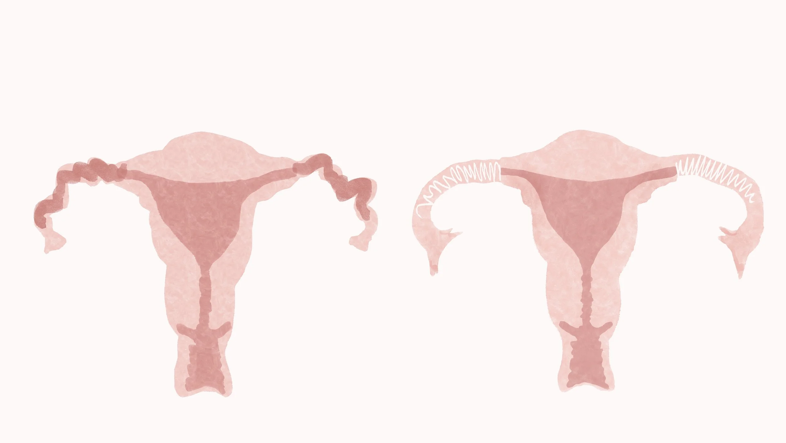 Uterine issues