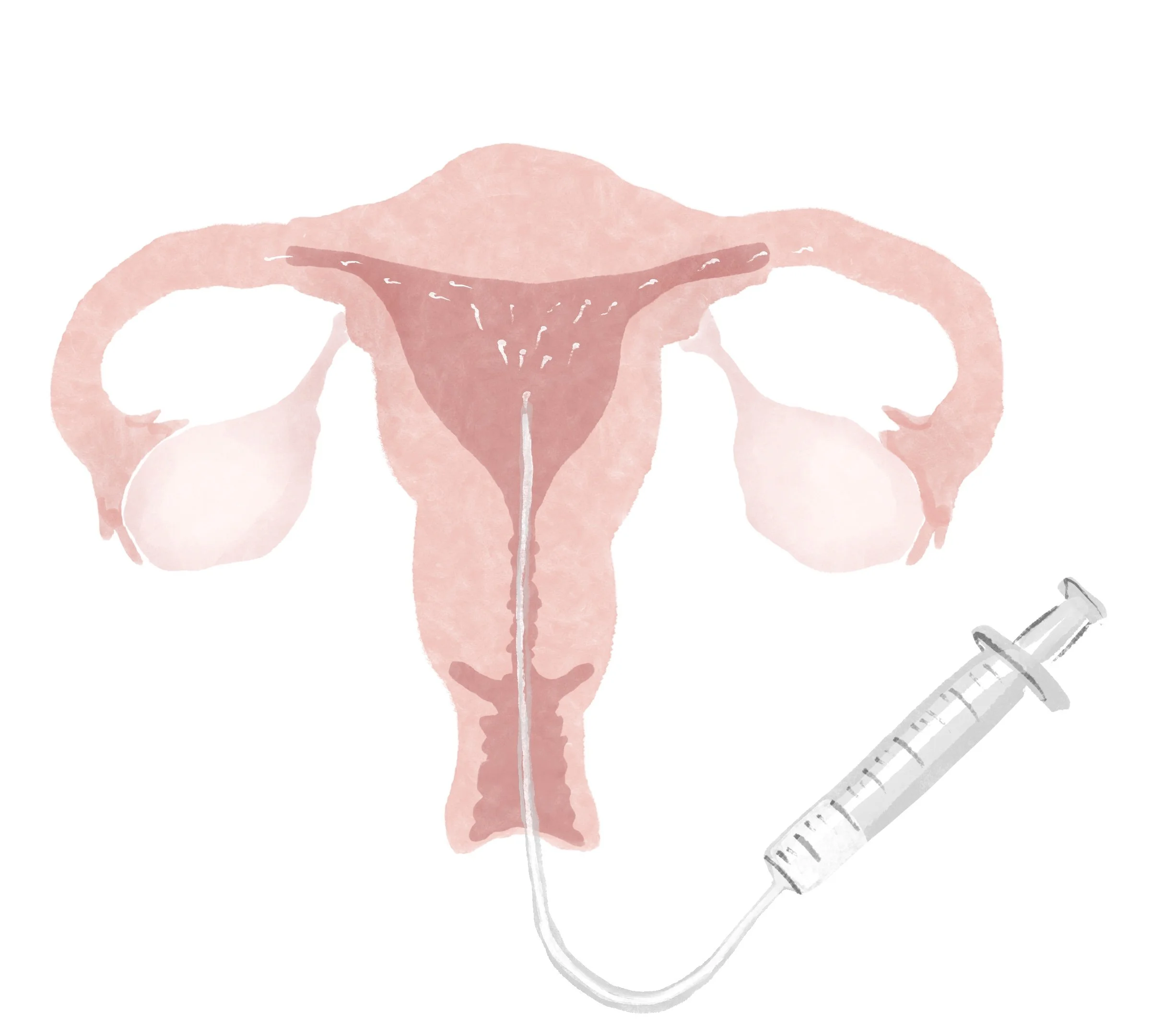 Intrauterine insemination (IUI)