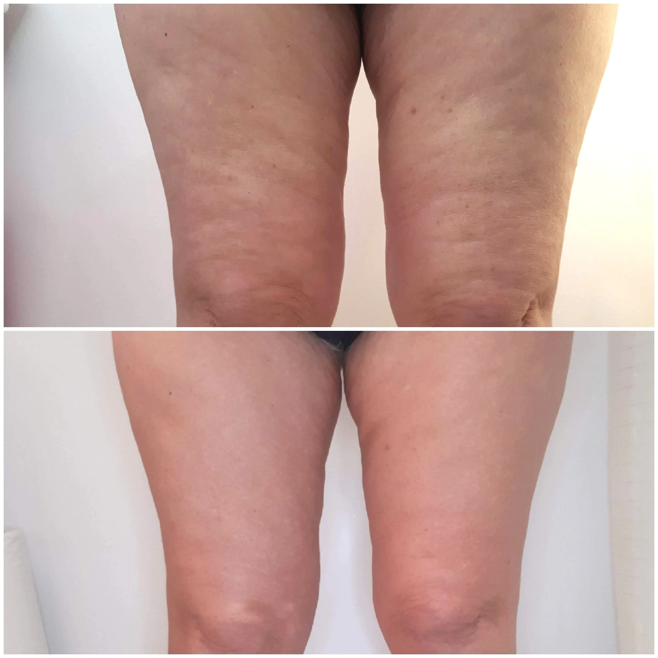 Lipofirm Body Contouring Legs