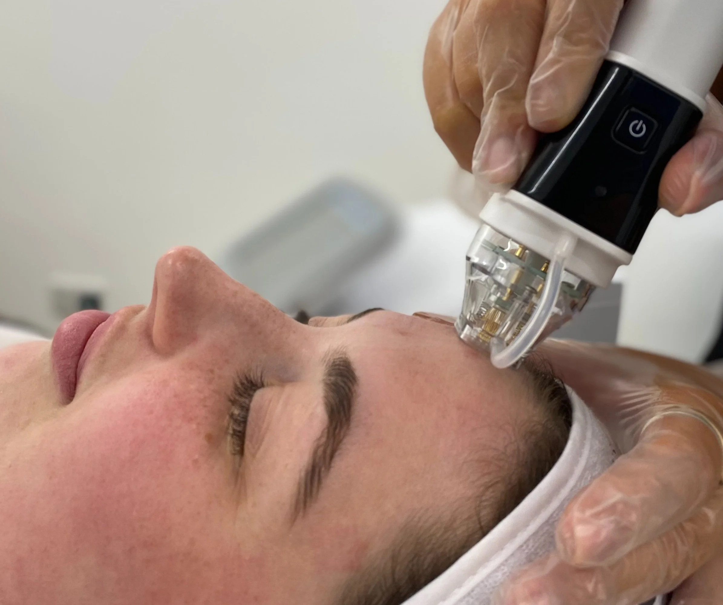 Why RF Microneedling Is Gold