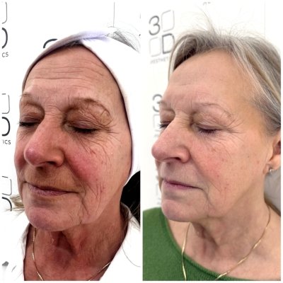 Radiofrequency Non Surgical Facelift