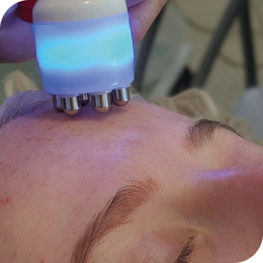 RADIOFREQUENCY NON SURGICAL FACELIFT