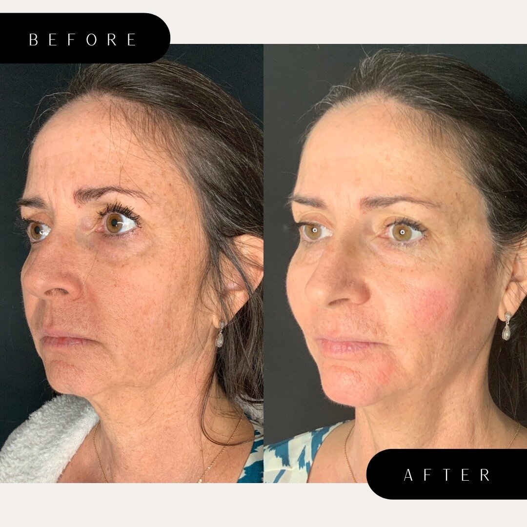 Sculptra is an FDA approved dermal filler made of poly-L-lactic acid that is injected underneath your skin where you want a fuller or smoother appearance. ⁠
⁠
Poly-L-lactic acid is a collagen stimulator that absorbs into your body a few days after tr