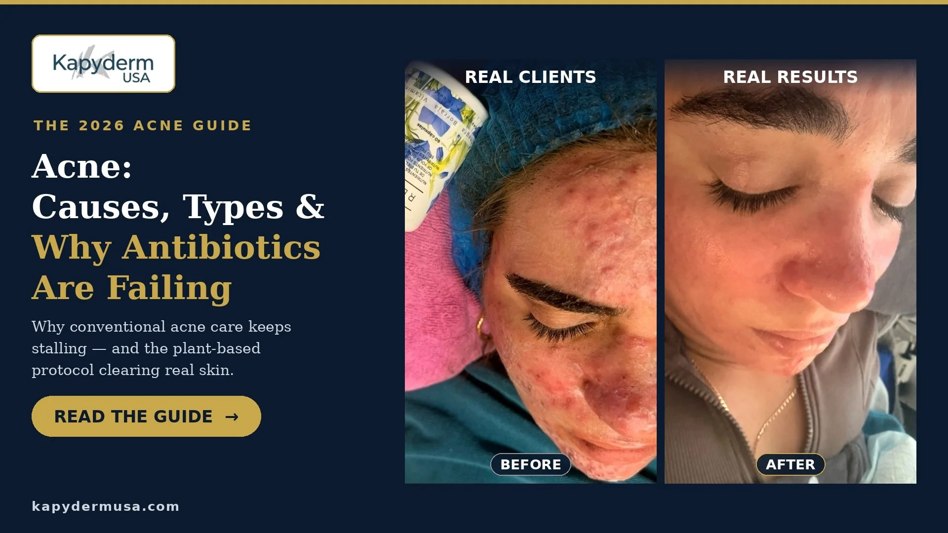 Cystic acne causes types and why antibiotics are failing 2026 clinical guide
