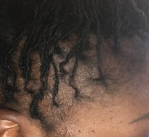 After — right side traction alopecia hairline restoration with dense terminal hair growth after plant-based Dermotricology protocol at Advanced Hair Growth Clinic
