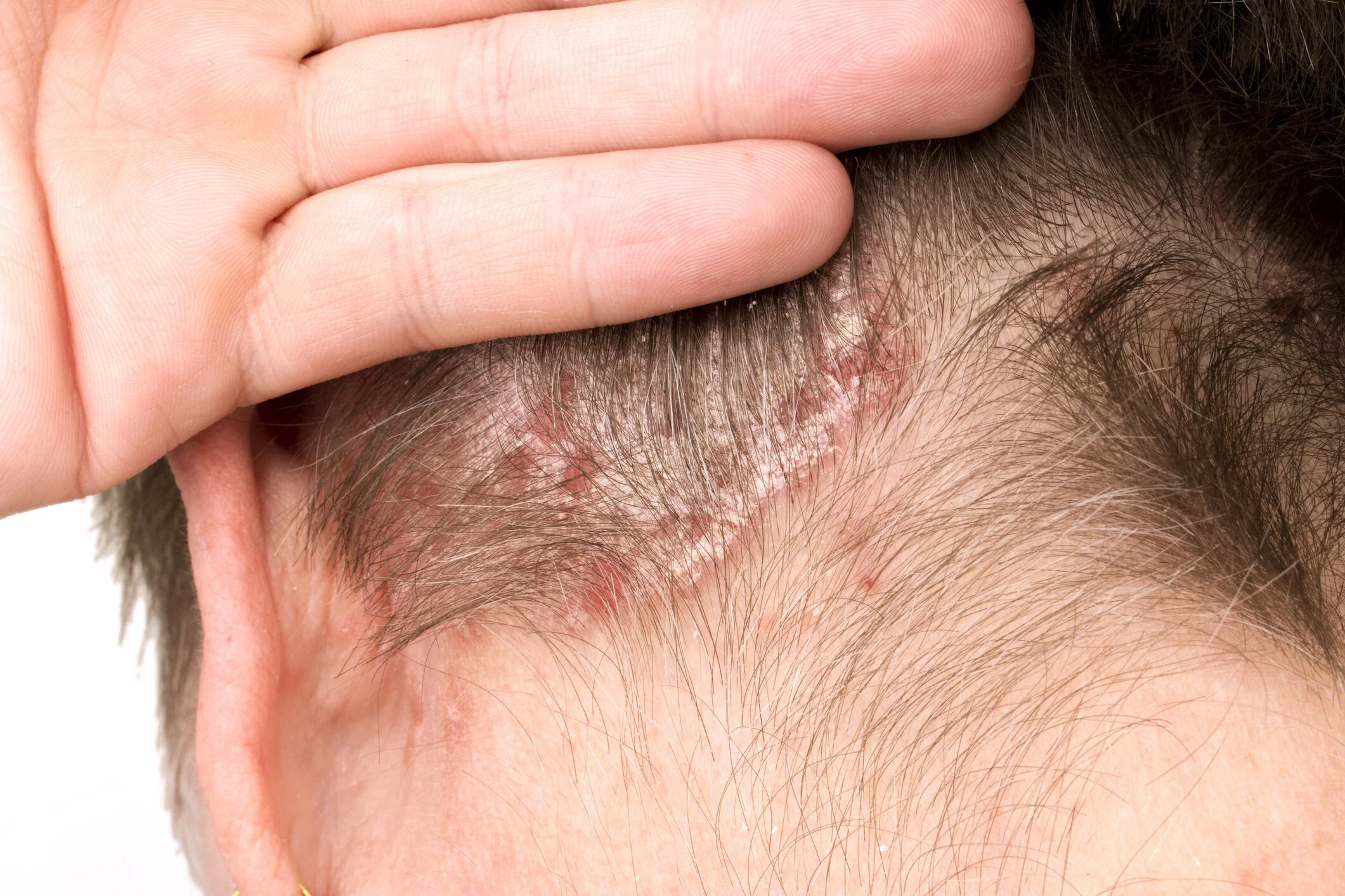 Psoriasis scalp