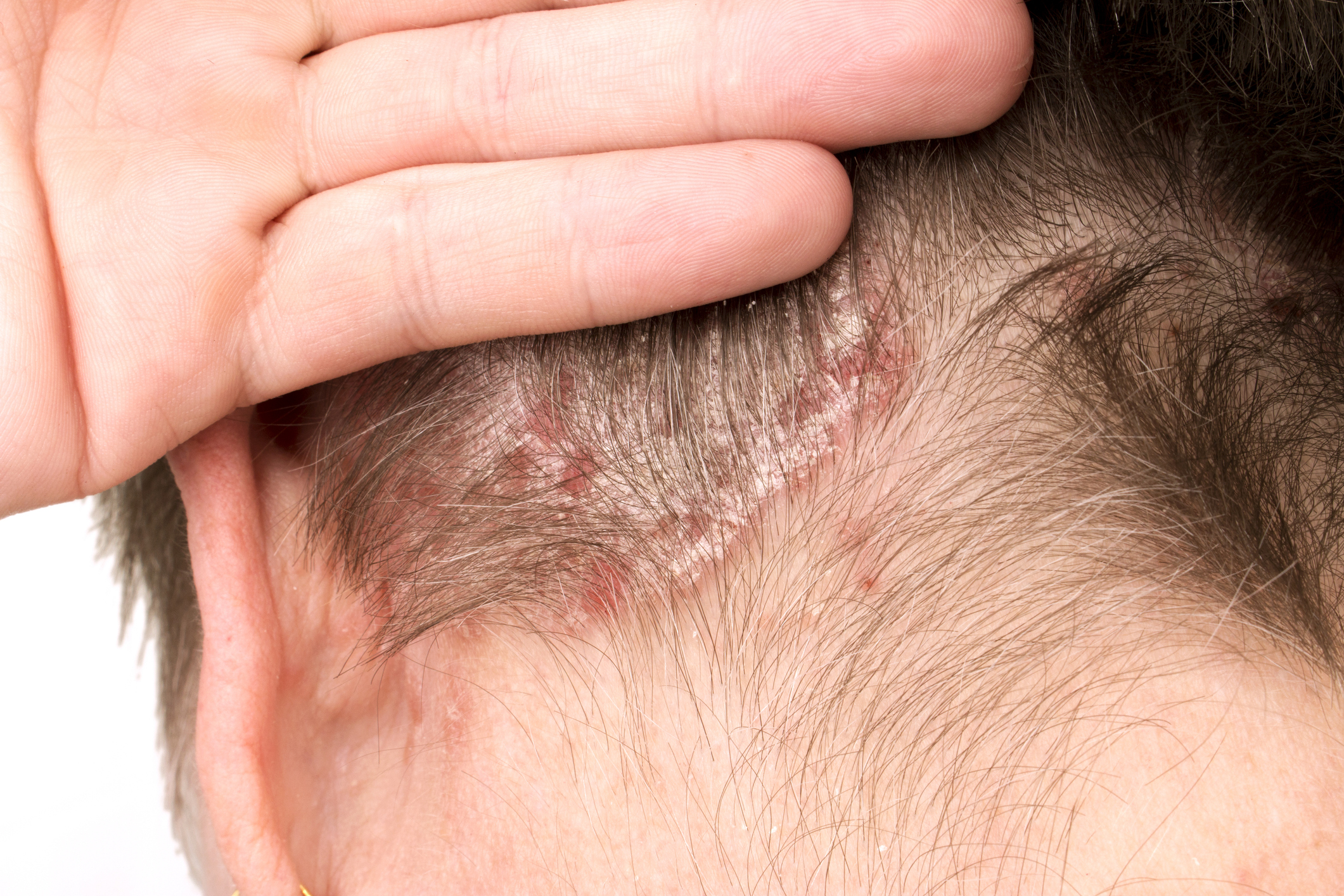 Everything You Need To Know About Seborrheic Dermatitis