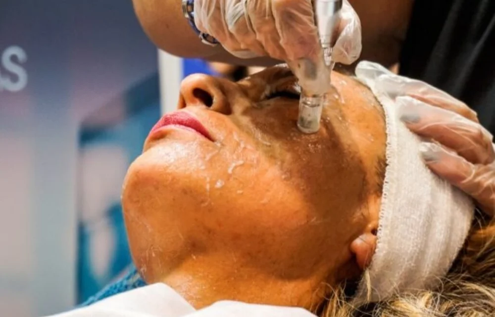 Kapydermia microneedling treatment being performed by a certified Kapyderm practitioner