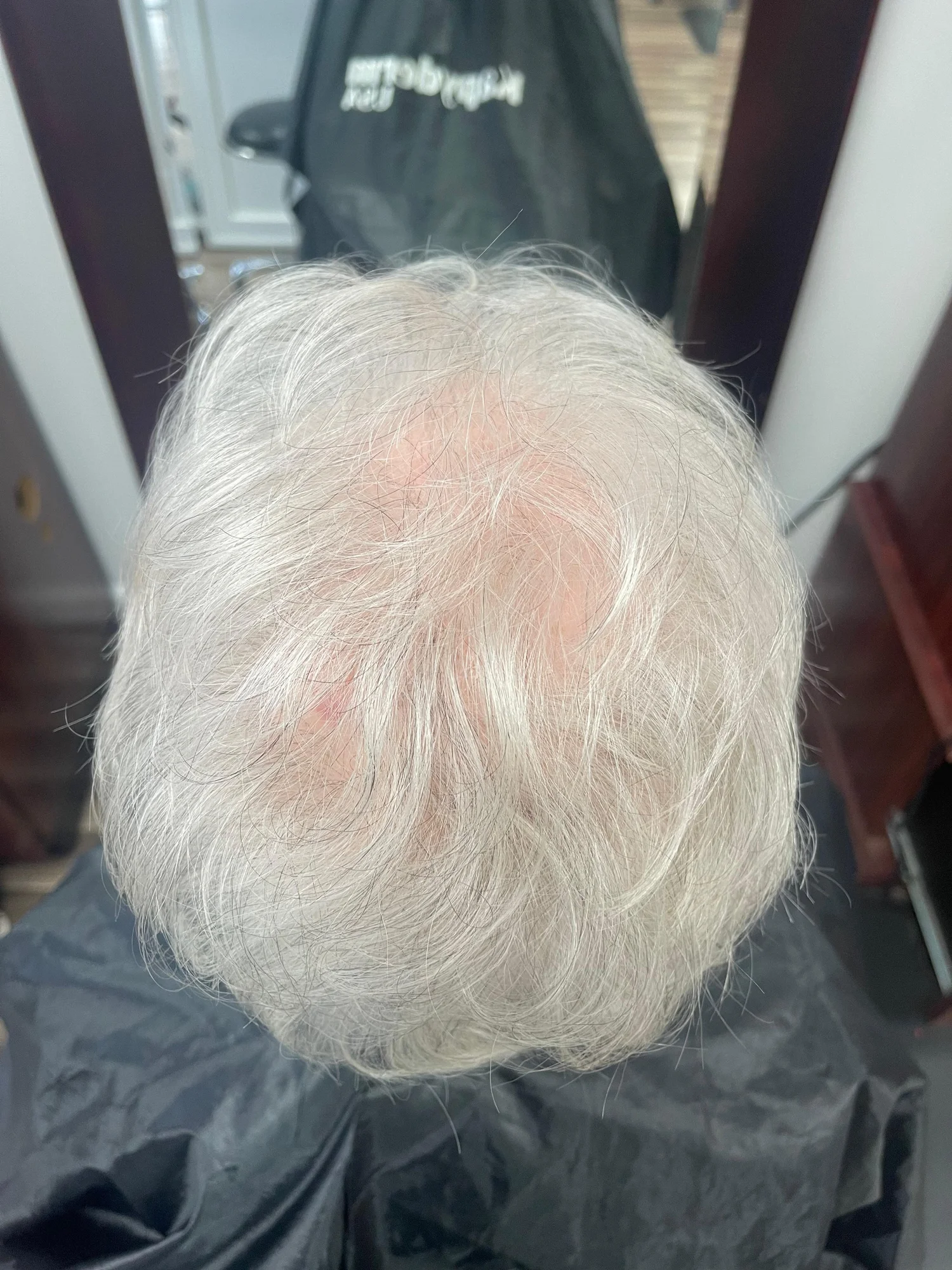 Before treatment — overhead view of Telogen Effluvium showing large exposed crown area with redness and severely sparse white hair before Dermotricology intervention