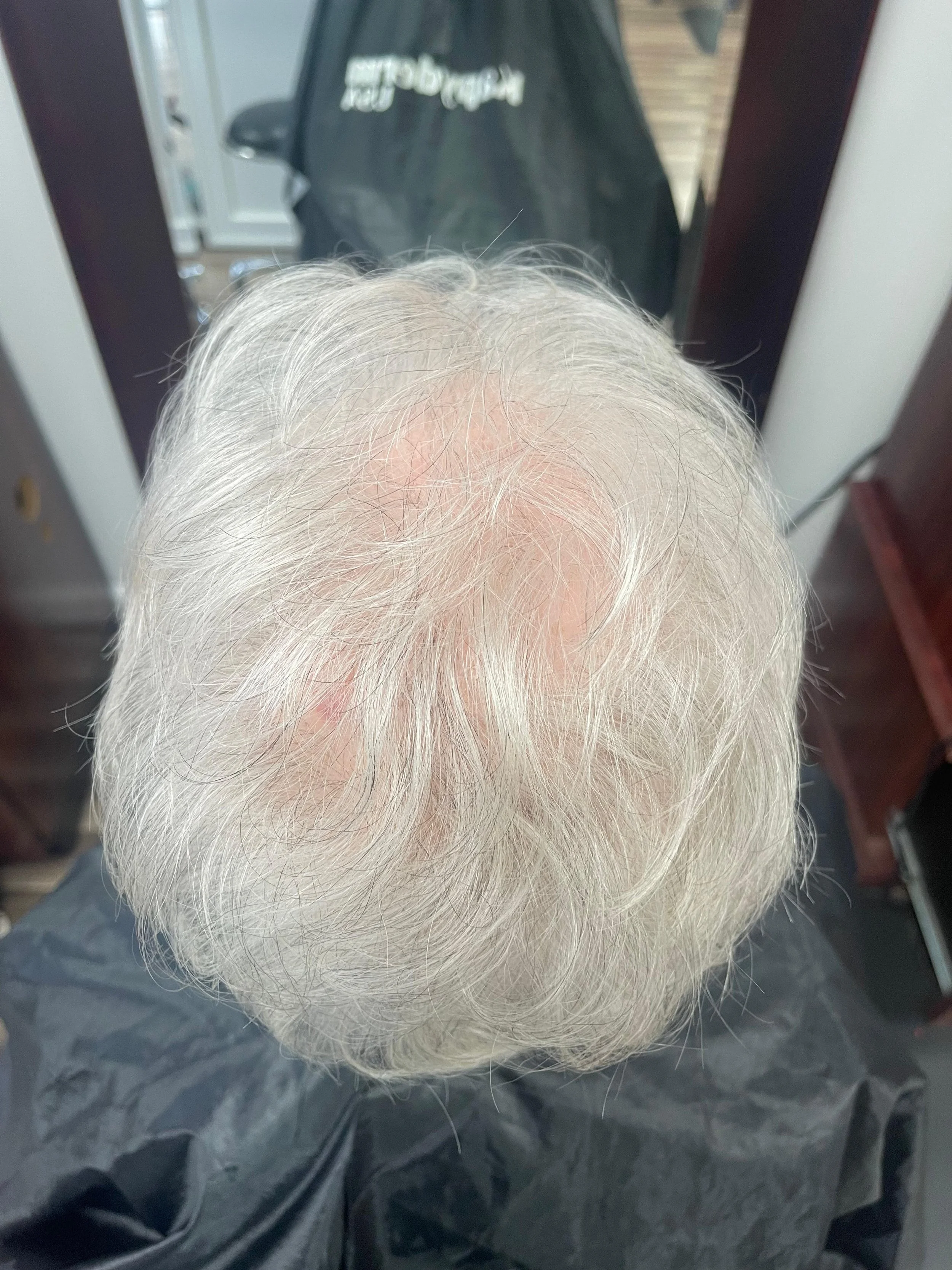 Before — stress-induced Telogen Effluvium in female patient late 70s showing severe crown hair loss and scalp exposure before Dermotricology intervention at Mendoza Dermotricology Solutions