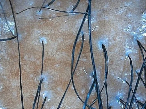 Close-up trichoscopy microscope view of scalp tissue displaying yellowish congestion and early perifollicular fibrosis around hair follicles.