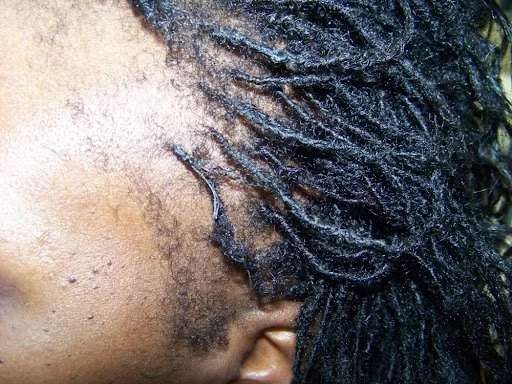 Left temporal view of mechanical hair loss showing stunted vellus hairs and localized dermal stress before Dermotricology intervention