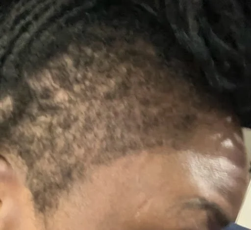 Right side profile of full hair recovery and dense edge restoration featuring a sharp taper haircut on natural coiled hair