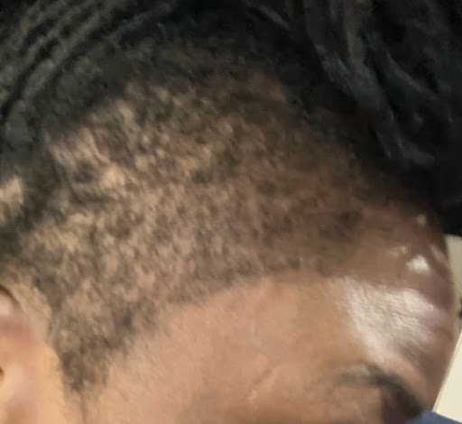 Final result — full hairline density restored, client wearing taper cut to show off completely restored edges after Dermotricology treatment at Advanced Hair Growth Clinic