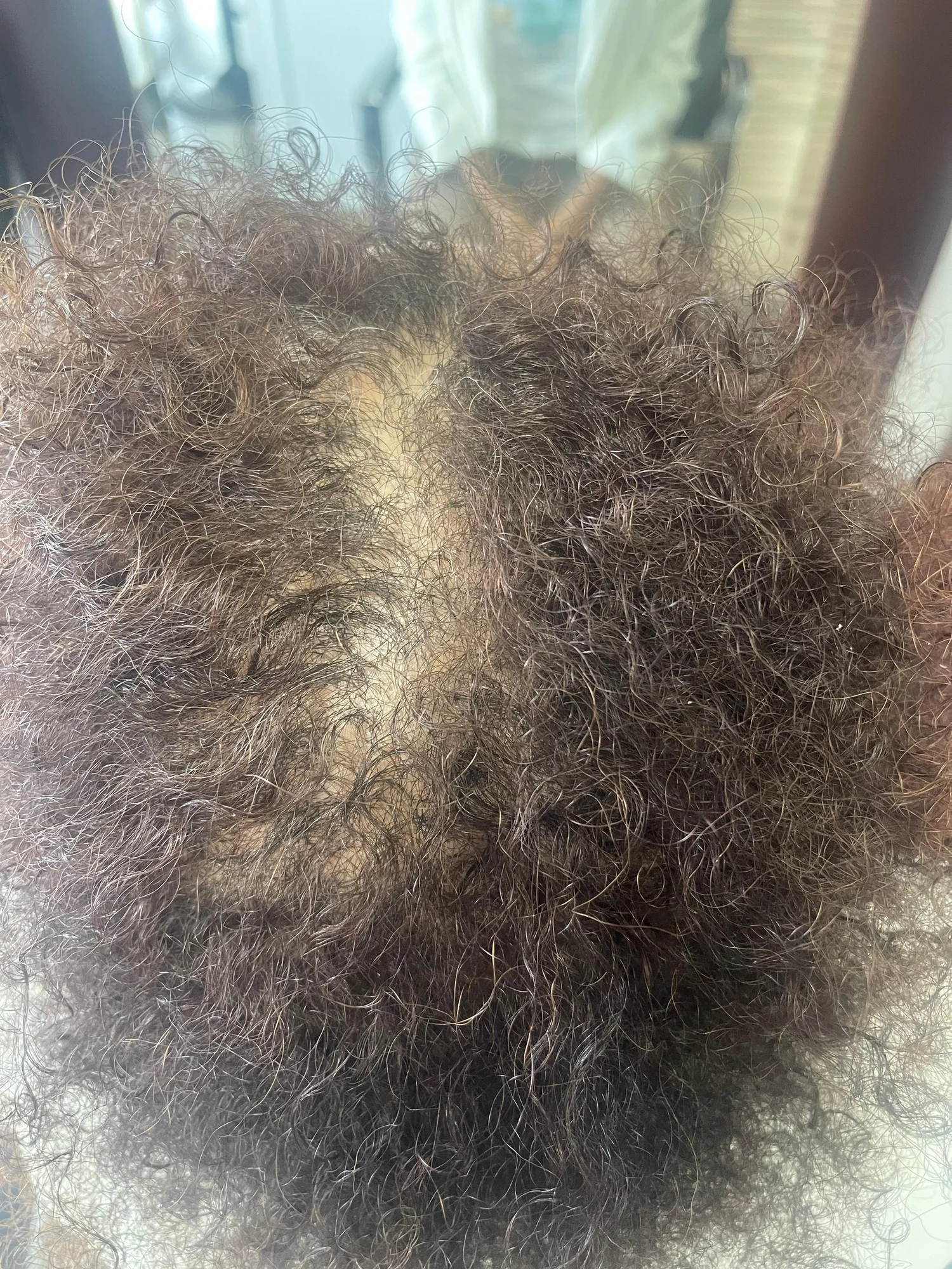 Before treatment — androgenetic alopecia crown thinning in 40-year-old female with coily hair, wide exposed part line at baseline, Mendoza Dermotricology Solutions Kapyderm Savannah
