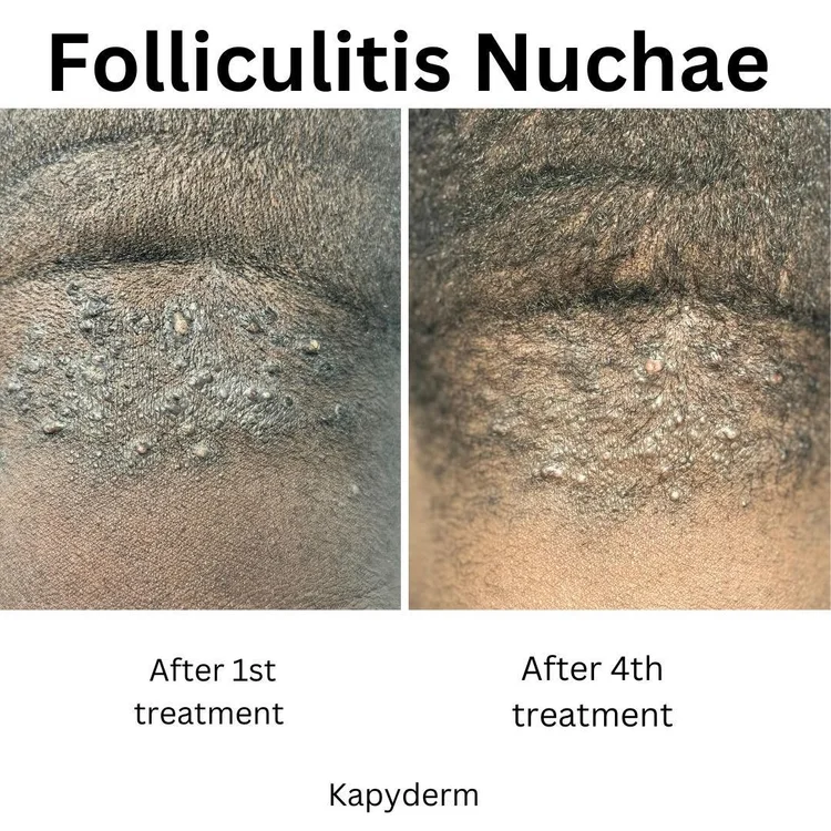 Progressive healing milestones for Folliculitis Nuchae showing reduction in tissue swelling after Kapyderm treatments
