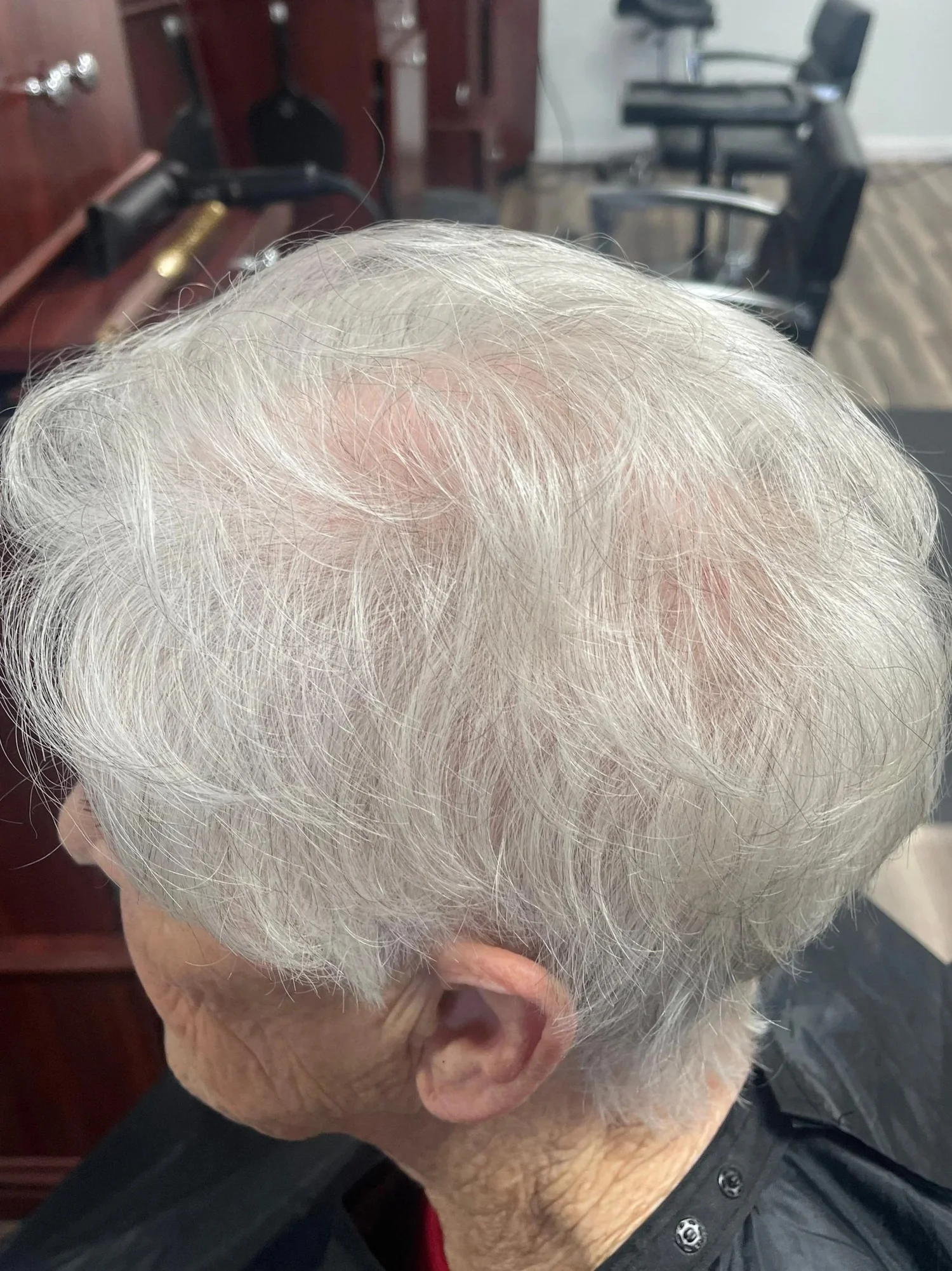 After 6-week Dermotricology protocol — side profile showing improved crown density and new hair growth in Telogen Effluvium patient at Mendoza Dermotricology Solutions Kapyderm Savannah