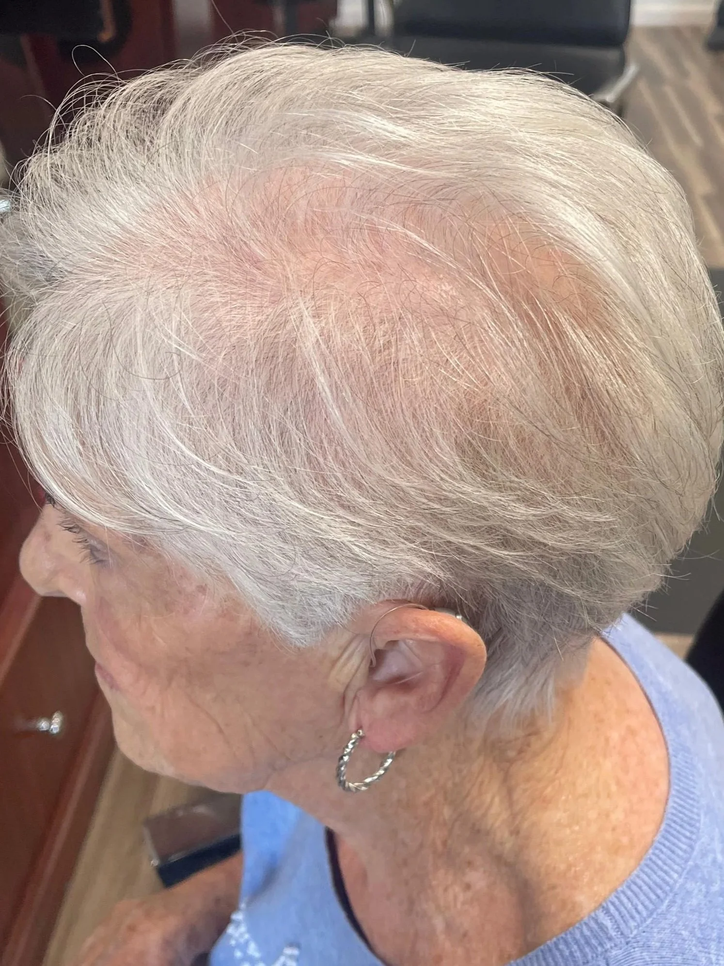 Before treatment — side profile view of Telogen Effluvium in female patient late 70s showing severe crown hair loss and scalp exposure at Mendoza Dermotricology Solutions