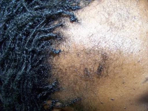 Before — severe traction alopecia right temporal hairline recession before Dermotricology treatment at Advanced Hair Growth Clinic Matthews NC