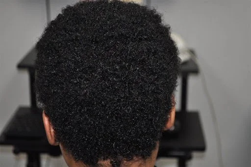 After view of full density hair restoration on a female scalp following a custom anti-inflammatory Kapyderm compounding protocol.