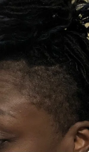 Left side view documenting successful traction alopecia restoration with robust hairline thickness and healthy scalp recovery