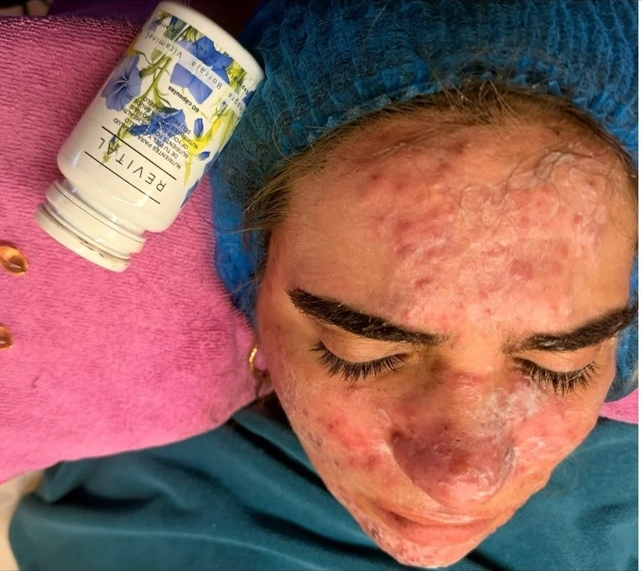 Before — severe cystic acne prior to Kapyderm Dermotricology protocol