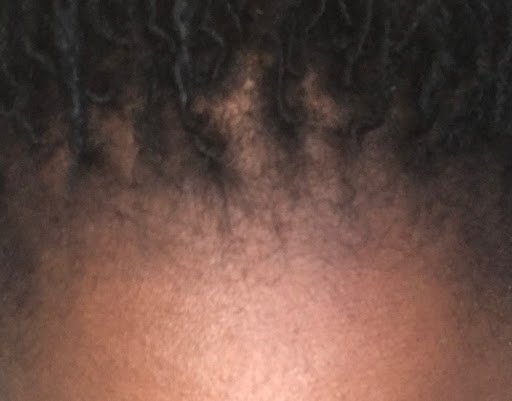 Close-up clinical view of newly re-awakened vellus and terminal hair follicles filling in previously thinned frontal hairline