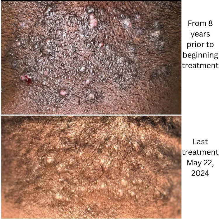 Before and after Folliculitis Nuchae treatment — Kapyderm USA Dermotricology protocol at Vitality Center by Lori, Williamsburg VA