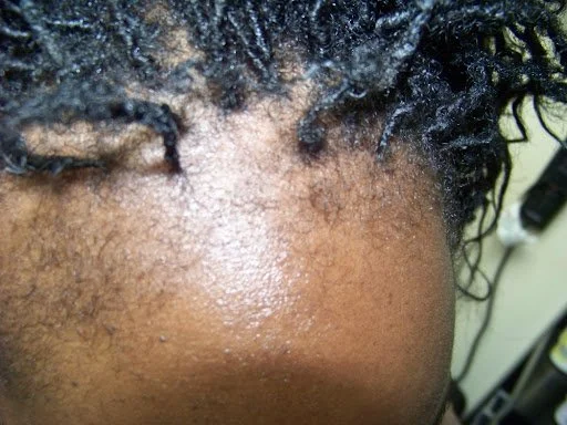 Frontal view of advanced hairline recession and thinning edges caused by mechanical tension from tight protective styling