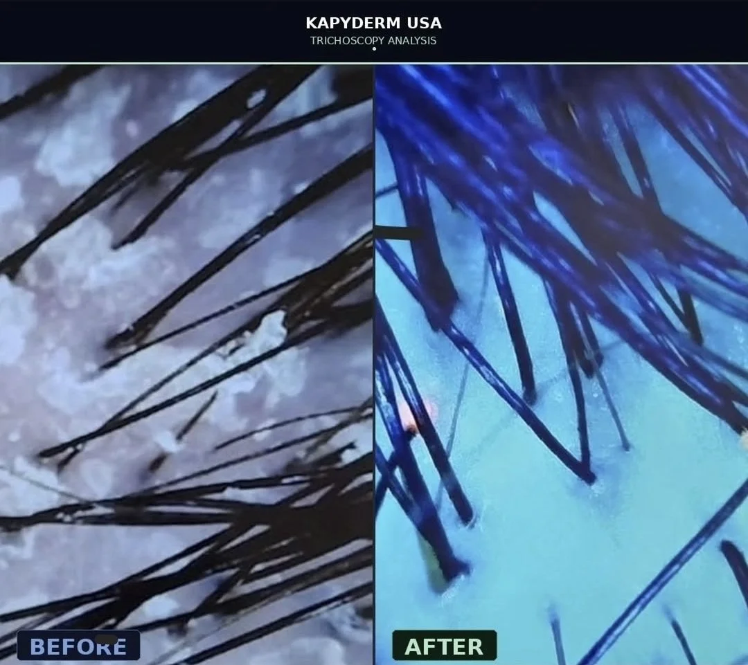 Kapykon scalp analysis imaging — before and after clinical documentation at a Kapyderm Authorized Treatment Center