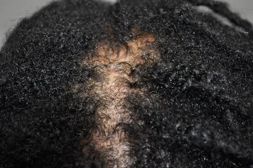 Overhead macro view of early-stage CCCA showing wide center parting and crown thinning before Dermotricology treatment