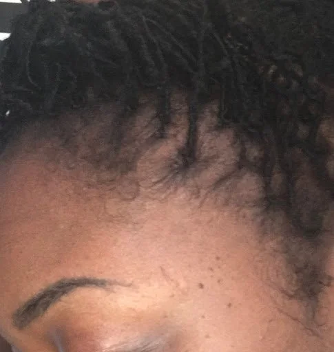 Side profile showing complete edge restoration and full hairline density following targeted scalp treatments at Advanced Hair Growth Clinic