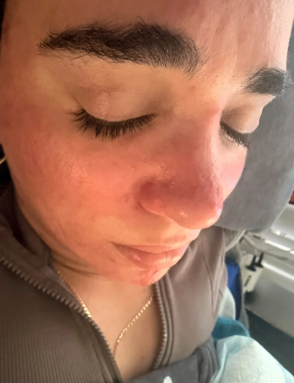 After — cleared skin following 5-month Kapyderm Dermotricology cystic acne protocol