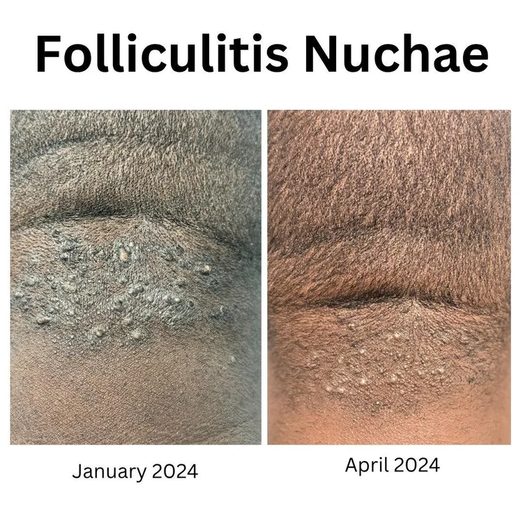 AKN clinical timeline restoration January to April at Vitality Center by Lori Williamsburg VA